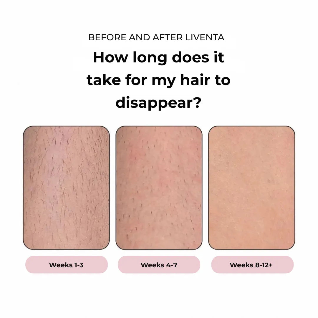 Liventa™ IPL Epilator